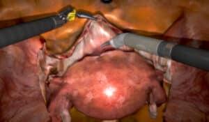bladder mobilization