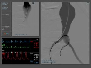 Peripheral Embolization