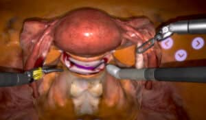 colpotomy