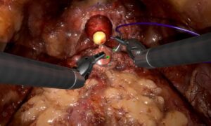 guided anastomosis
