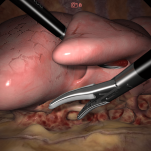 VATS Lobectomy