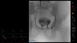 Embolotherapy HCC & UFE
