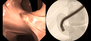 ERCP