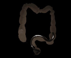 LowerGI