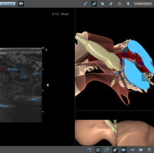 brachial plexus nerve block